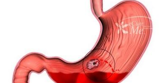 Mide Kanaması Nedir?